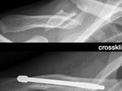 Frattura clavicola Fabian Cancellara: radiografia