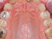 Denti devitalizzati: nemico salute?