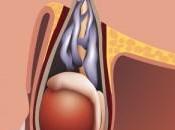 Varicocele, cos’è come curarlo