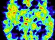 Sclerosi Multipla: scienza, statistica CCSVI