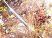 sindrome piriforme