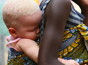 caccia neri bianchi: disgrazia nascere albini Tanzania