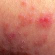 Come combattere Dermatite