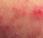 Come combattere Dermatite