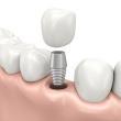 Focus sulle Protesi dentali fisse mobili