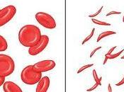 Anemia falciforme