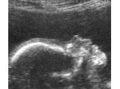 Ungheria, bimbo nato sano giorni dopo morte della madre