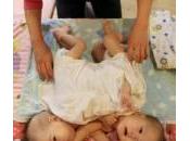 Cina: Zheng Zheng, gemelli siamesi abbandonati orfanotrofio (Foto)