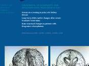 Sclerosi Multipla: sulla CCSVI lettera ricercatori Ferrara