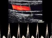Sclerosi Multipla: utilizzo programma MEM-net mappatura della valutazione ecocolordoppler CCSVI