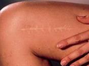 Cicatrici: degli essenziali Salute