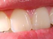 Gengiviti ulcerazioni orali come curarle essenziali Salute