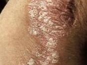 Psoriasi