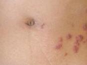 Herpes zooster