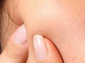 acne vulgaris dieta