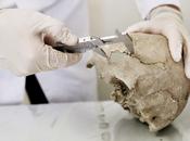 Trapanazione cranio...bizantina