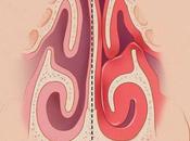 Spray nasale green sinusite parte quinta