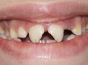 Questo mese parliamo TRAUMI DENTALI nell’infanzia adolescenza