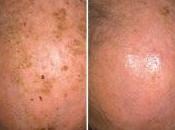 MILANO. dispositivo medico combattere cheratosi attinica