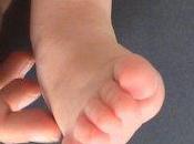 Neonati: metodo Ponseti cura piede torto congenito