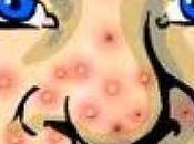 Acne: curarla essenziali