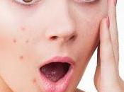 MILANO. milioni adolescenti Italia soffrono acne medico curandosi fai-da-te.