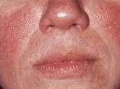 MILANO. Rossore, eritema, couperose sono davvero solo problema estetico?