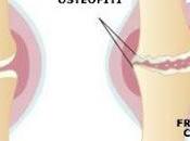 MILANO. Articolazioni rischio obesità sovrappeso: Italia milioni persone osteoartrosi, metà sono obesi.