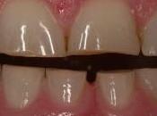 Dottore, figlio notte digrigna denti! grave? bruxismo bambini