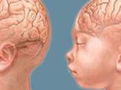 Cos’è microcefalia infantile?