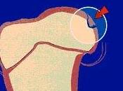 L’Osteocondrite Dissecante (OCD) della Spalla Cane.