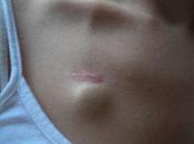 truffa choc (per malati tumore)