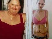 Anoressia Obesità rischia vita!
