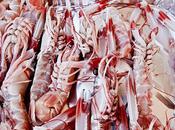 Frattura processo spinoso Giorno Cervical spinous process fracture.