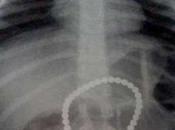 Mangia calamite, bimba lotta vita morte